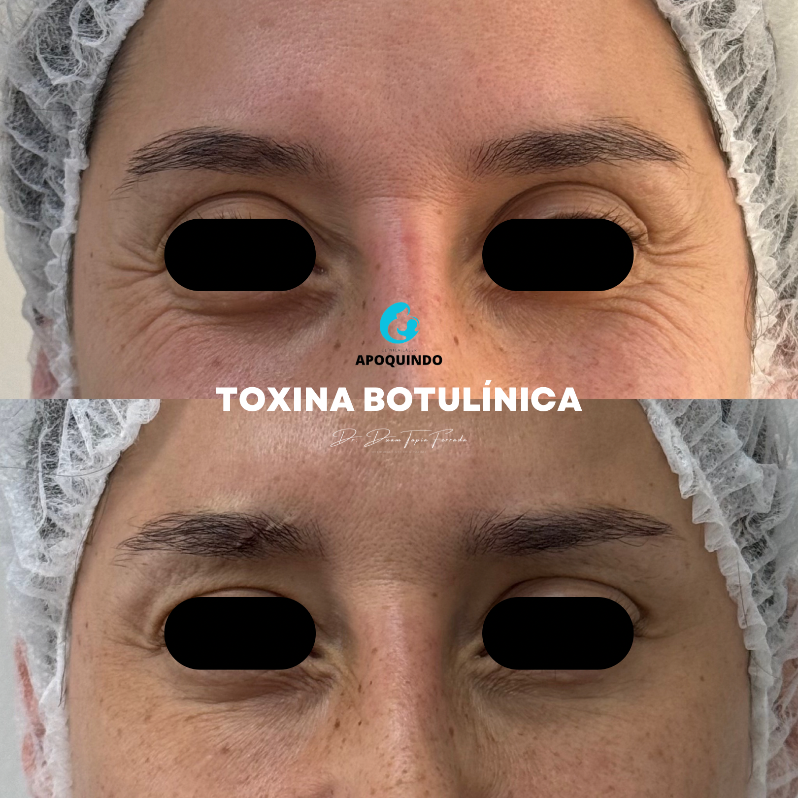 Botox resultado